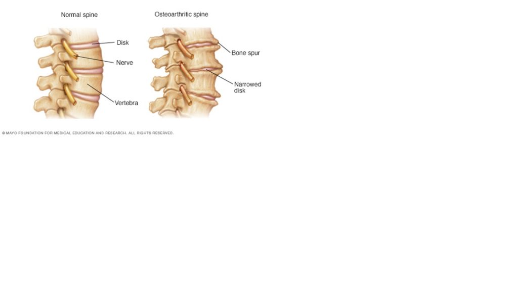 Spinal Osteoarthritis Picture Disability Counsel